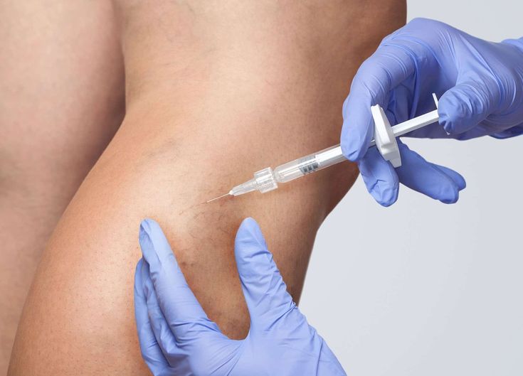 Spider Veins treatment – Truelife Kosova